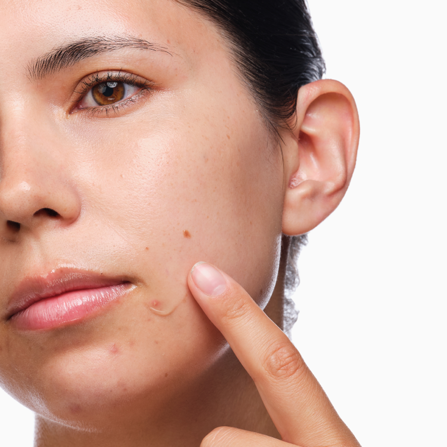 the-acne-set-s4 rdn-the-acne-set-application.png