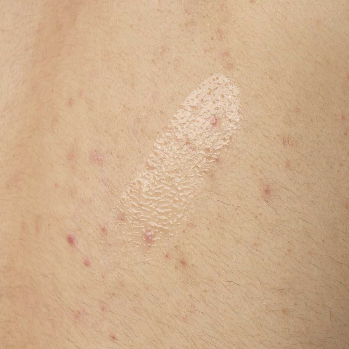 salicylic-acid-0-5-body-serum-s0 ORD-salicylic-acid-05-body-240ml-application.jpg