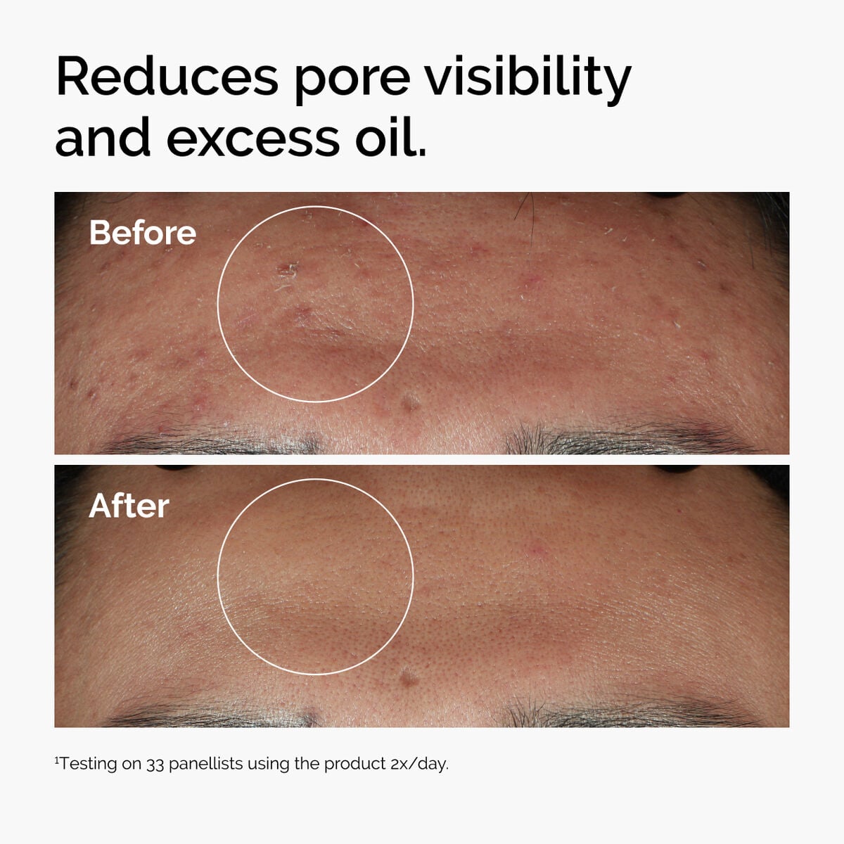 niacinamide-10-zinc-1-j7 ord-niacinamide-zinc-blemish-serum-before-after-pores.jpg
